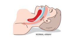 Diagram of free flowing air during normal sleep breathing